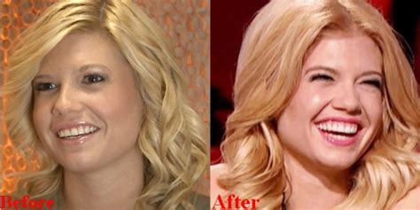 chanel west coast teeth|chanel west coast face change.